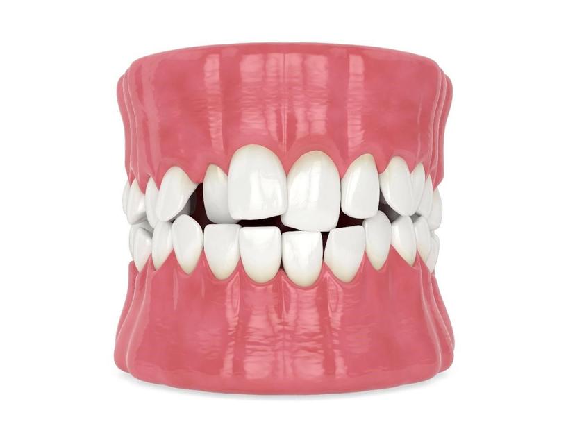 Teeth Overcrowding Not Letting You Flaunt Your Smile? Here’s All About Fixing It