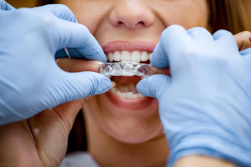 3 Reasons Lingual Braces Are Gone for Good!