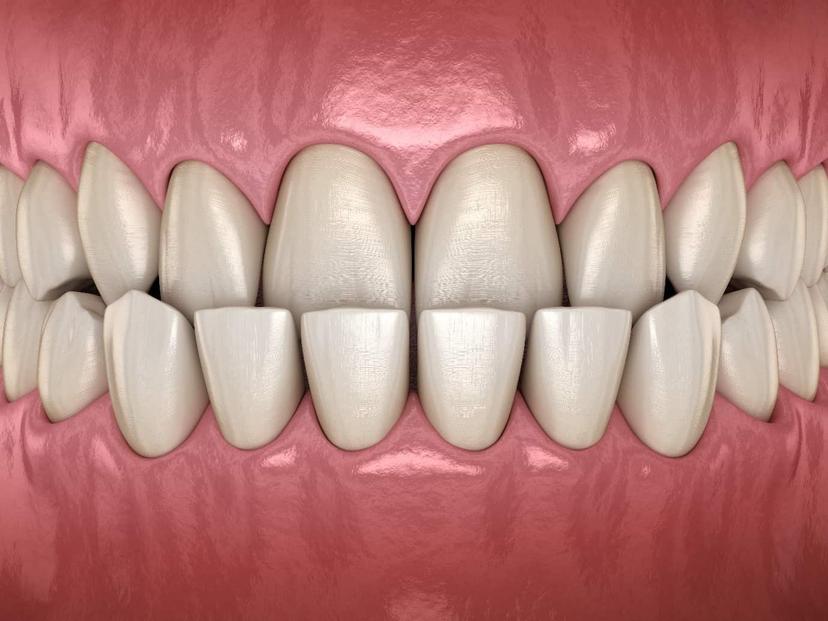 Here's An A-Z Guide on Fixing Your Underbite Teeth with Our Clear Aligners