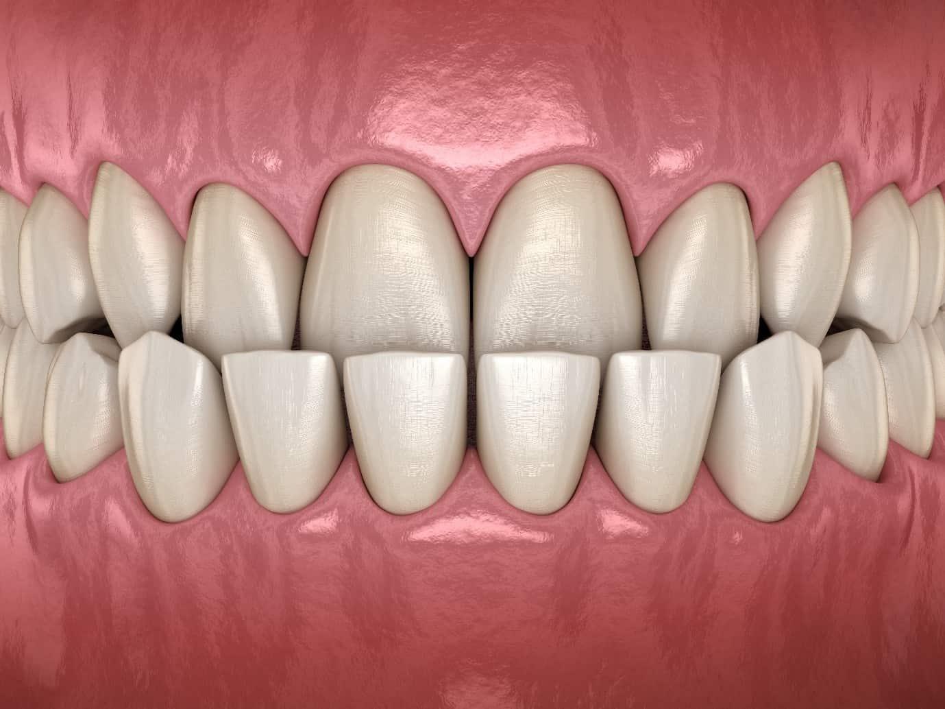 Inlay dental 