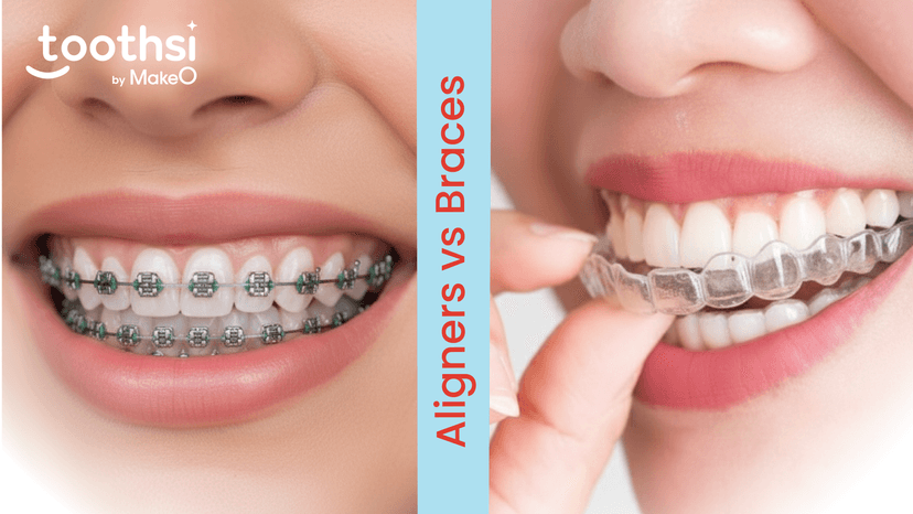 Aligners VS Braces: Cost, Comfort & Results Compared
