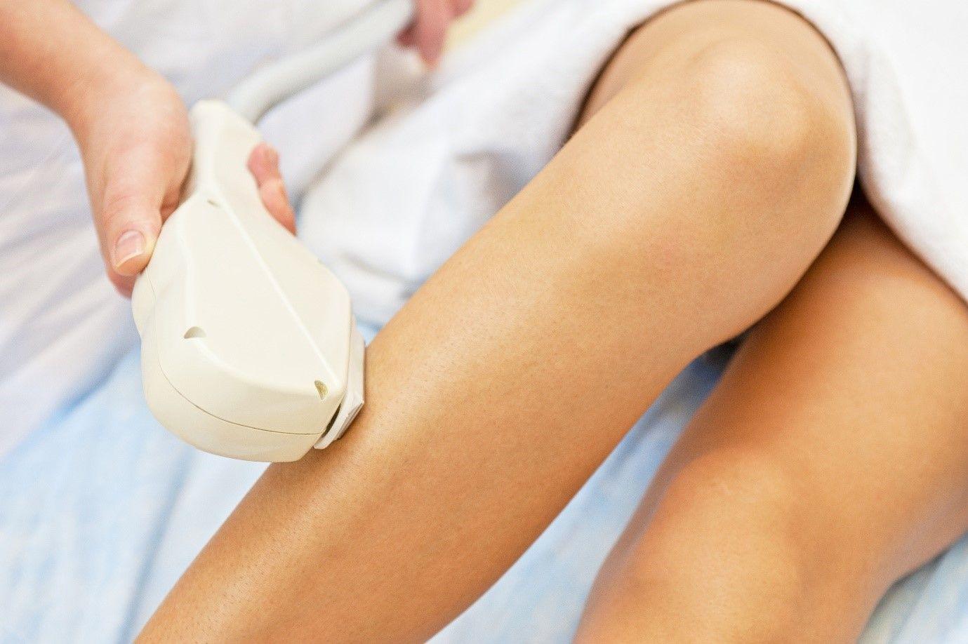 Benefits of laser hair removal