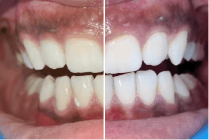 before-after