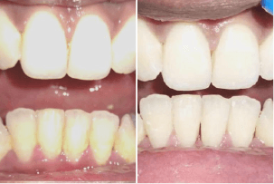 before-after