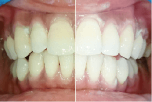 before-after