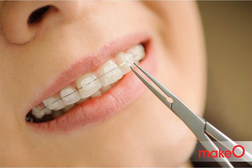 4 Foods to Avoid While Wearing Ceramic Braces 