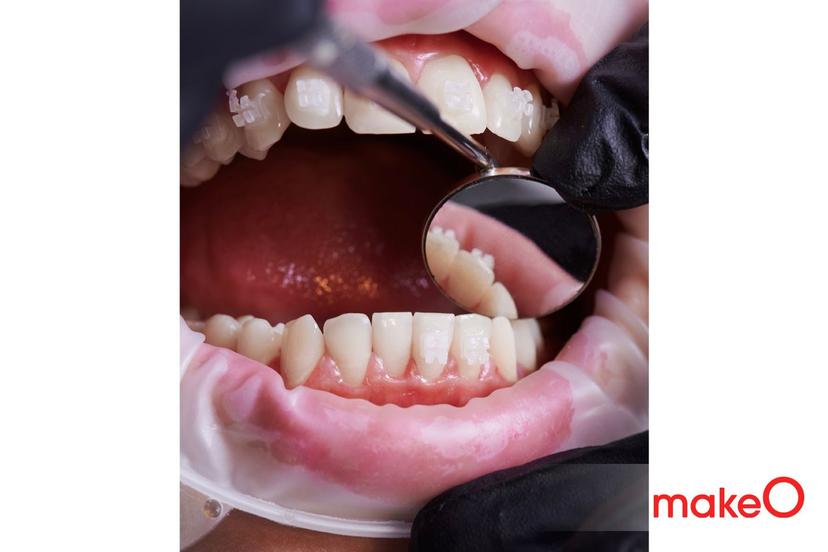 A Simple Guide to Choosing the Perfect Cheek Retractor 
