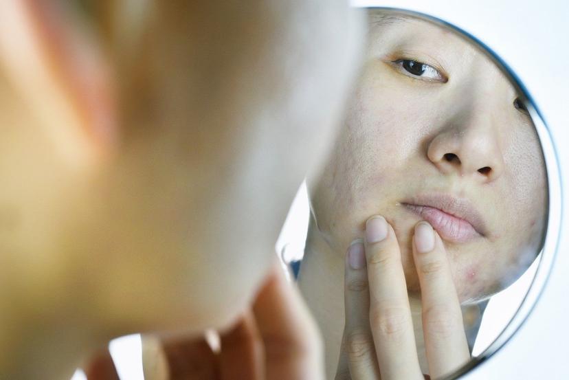 Don't Overlook Cystic Acne: Understand its Causes and Treatments