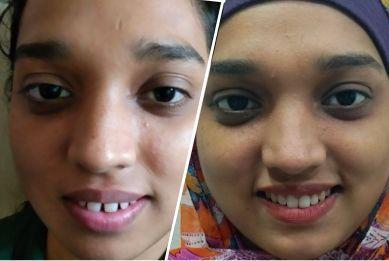 before-after