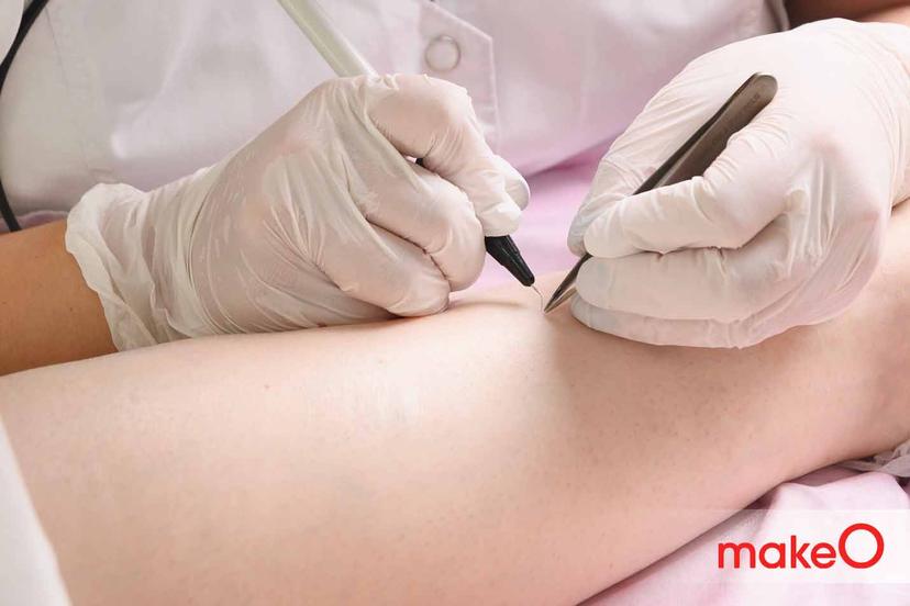What is Electrolysis for Hair Removal?