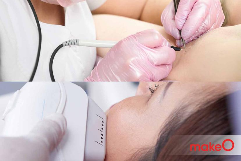 Electrolysis vs Laser Hair Removal - Know the Difference