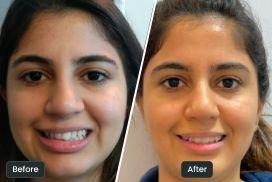 before-after