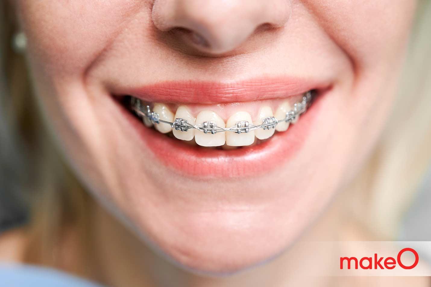 braces in adulthood
