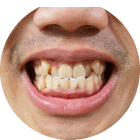 Plaque &Tartar Build-Up