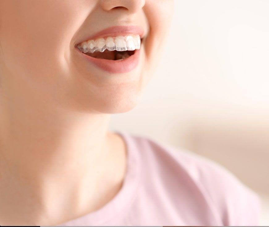 discomforts of clear aligners