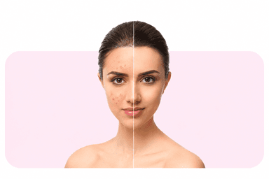 Acne & Scar Treatments_image