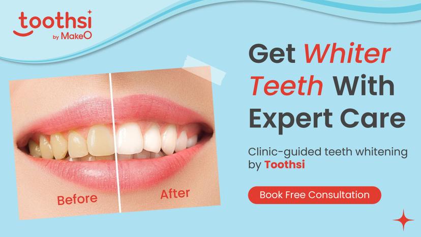 Teeth Whitening: Everything You Need to Know Before You Start