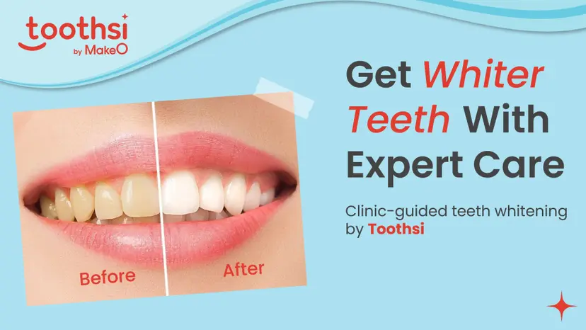 Teeth Whitening: Everything You Need to Know Before You Start
