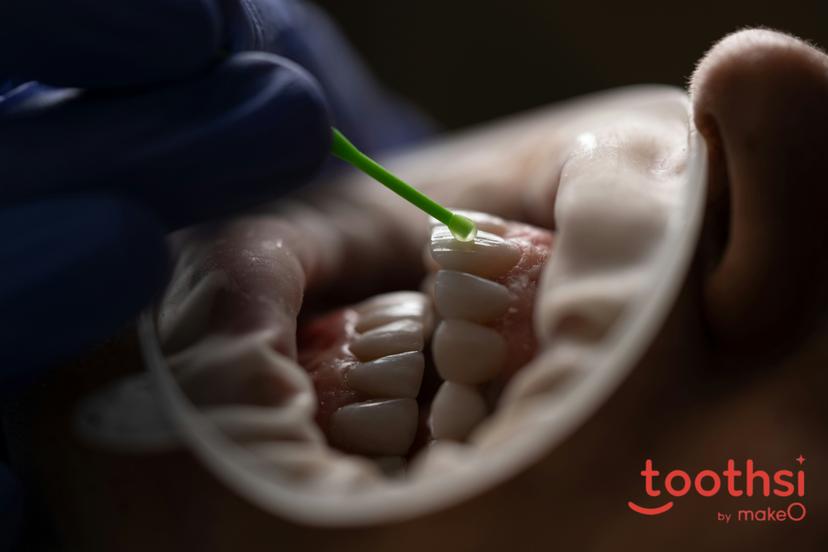 Buck teeth: how invisible aligners can help