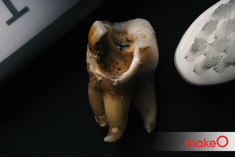 Wisdom Tooth Extraction: Do’s and Don’t You Should Follow