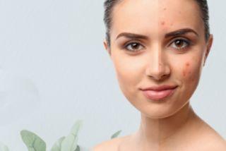 4 Simple Tips to Build An Acne-Fighting Skincare Routine