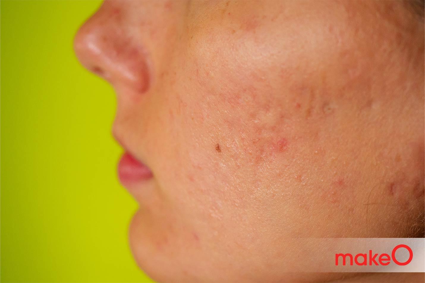 inflamed acne