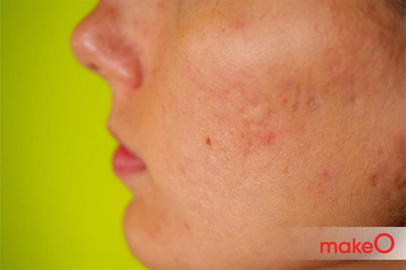 How to Tackle Acne Inflammation or Redness : A Brief Guide