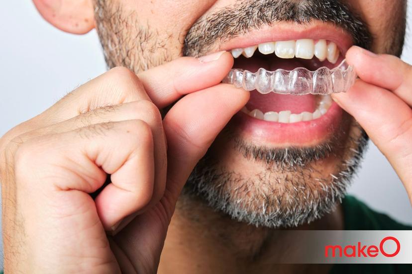 Know All About The Benefits of Wearing Retainer For Teeth