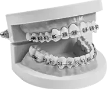 braces