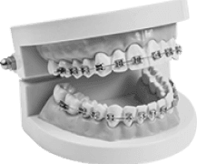 wired and metal braces for teeth