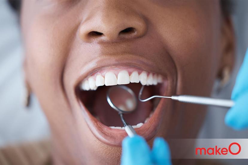 Dens Invaginatus or Dens in Dente: Causes, Treatment and Prevention Tips