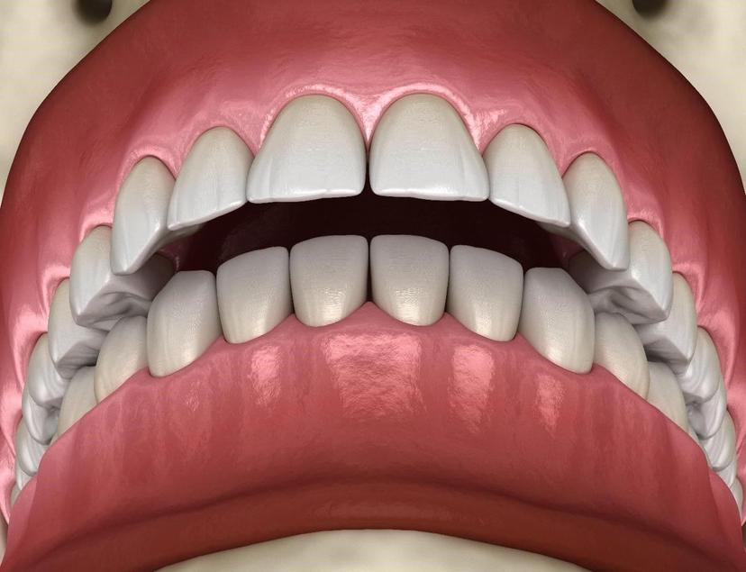 This Valentine's Day, Don't Let an Overbite Stop You from Smiling! Here's How to Fix It.