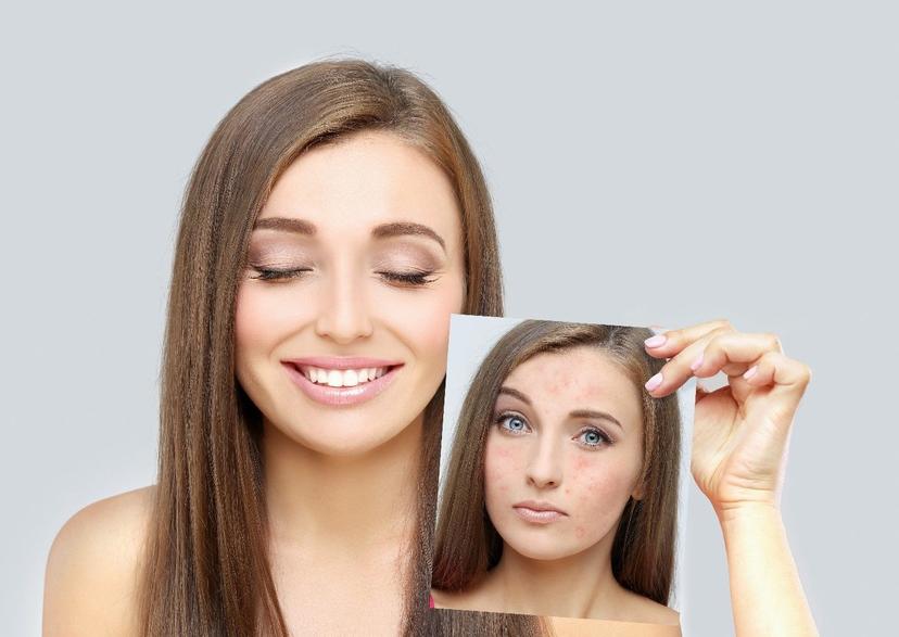 Here are 6 Ways to Get Rid of Stubborn Pimple Scars