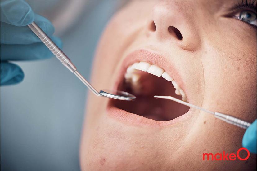 Bleeding gums treatment at home:All you need to know