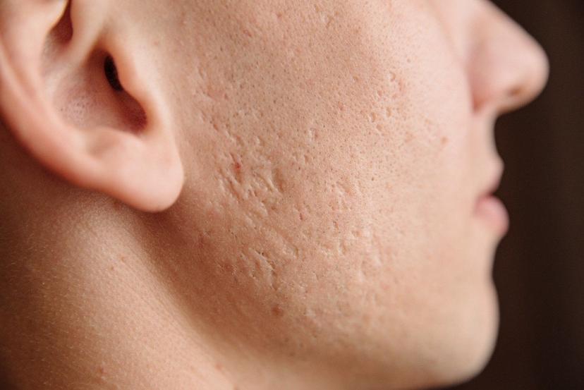 How to Get Rid of Acne Scars: Top Secrets Exposed