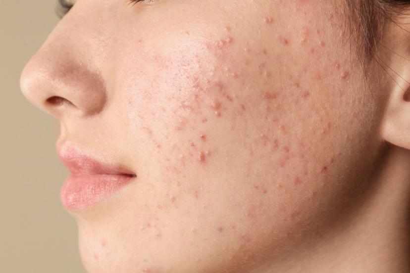 Pimples On The Face? These Home Remedies and Treatments Can Help!