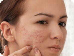 Remedy for blackheads and how they are caused!