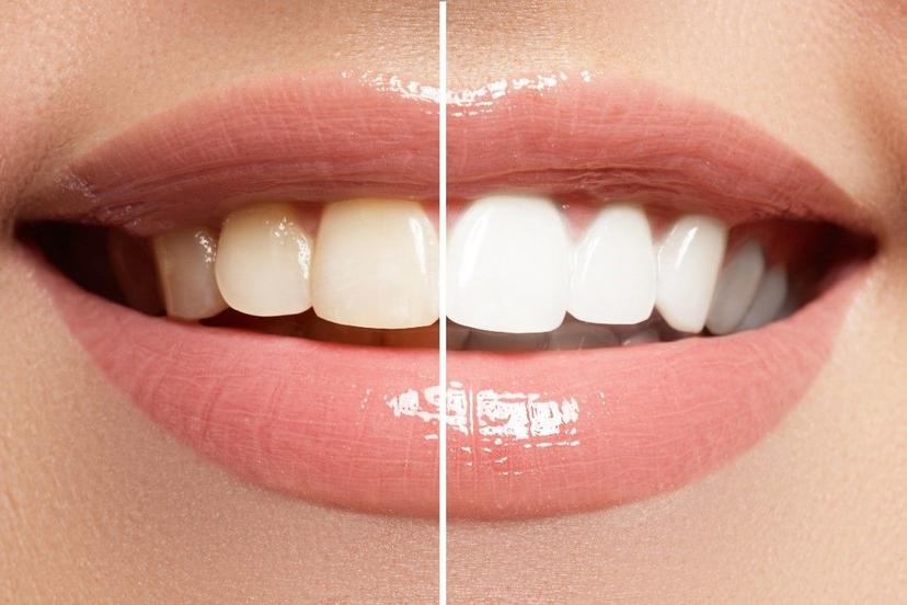4 Ways for Natural Teeth Whitening at home