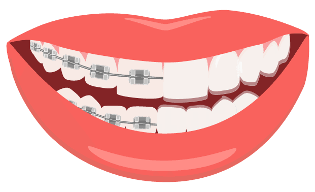 toothsi Aligners: Fix Teeth Misalignment with Clear Aligners at Home ...