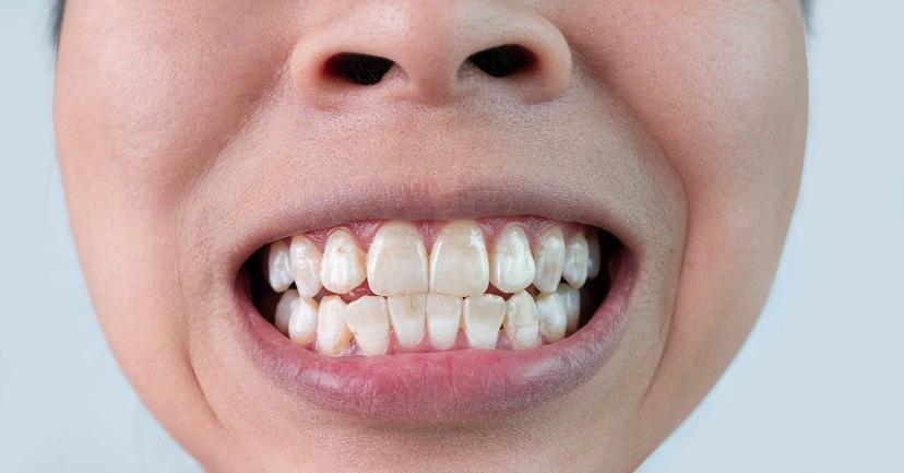 White Spots on Your Teeth: 4 Things to Know