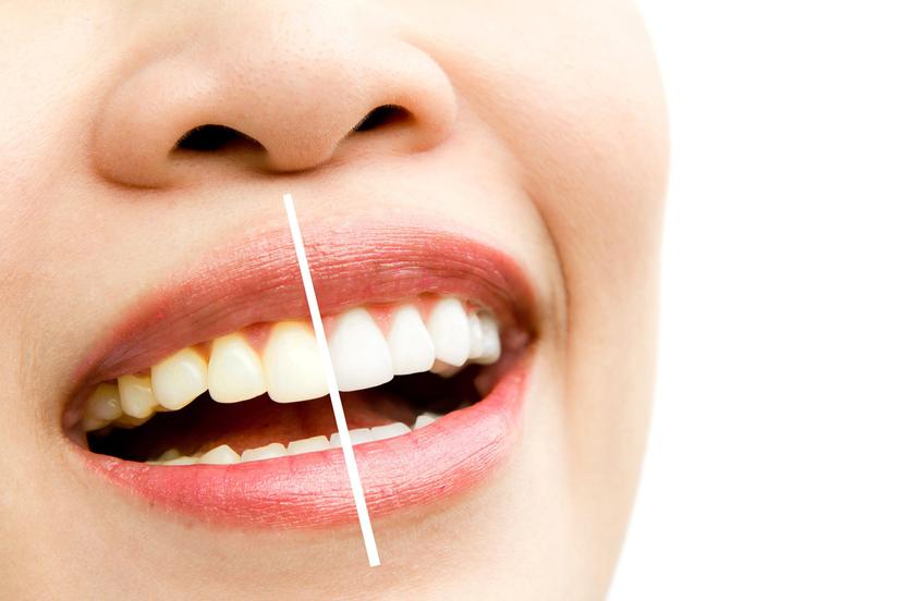 Avoid these teeth staining foods